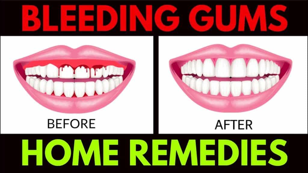 How To Stop The Gums From Bleeding Practice good oral hygiene. Bleeding gums may be a sign of poor dental hygiene. ... Rinse your mouth with hydrogen peroxide. ...