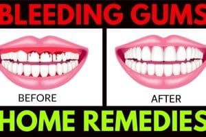 How To Stop The Gums From Bleeding Practice good oral hygiene. Bleeding gums may be a sign of poor dental hygiene. ... Rinse your mouth with hydrogen peroxide. ...